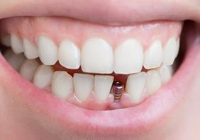 Smile with dental implant