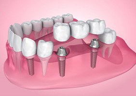 Exploded illustration of dental implants with bridge