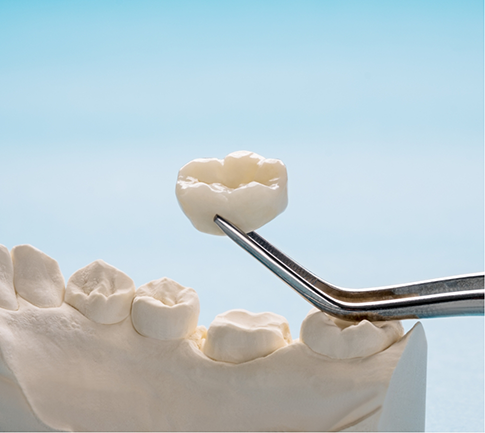 Lifting dental crown in Conyers off of model of teeth