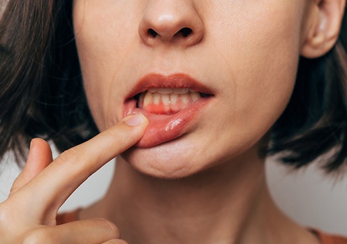Patient lifting lip to show gum disease