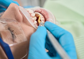 An illustration of scaling and root planing gum disease treatment in Conyers 