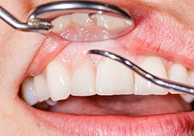 Dentist correcting gum recession in Conyers