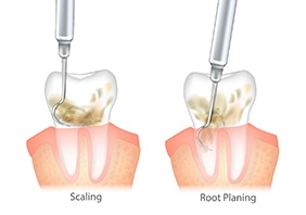 A drawing of each stage of scaling and root planing