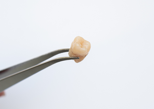 Dental instrument holding tooth after a tooth extraction in Conyers