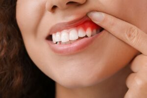 Woman pulling up lip to reveal red gums. 