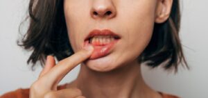 Woman pulling down lower lip exposing red gums.