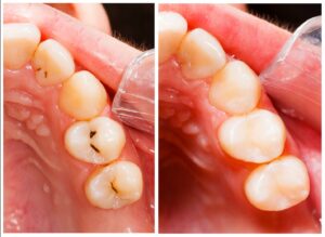 Before and after pictures of cavities filled with tooth-colored fillings.