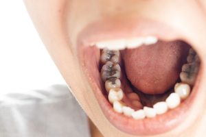 Someone opening mouth to reveal several amalgam fillings